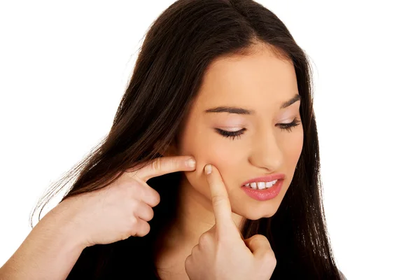 Teenage woman squeezing pimple. — Stock Photo, Image