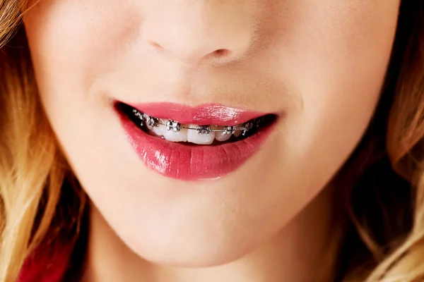 Close up open mouth with braces on teeth. — Stock Photo, Image