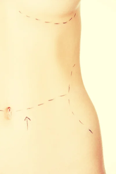 여자 배꼽 성형 수술을 위한 표시. — 스톡 사진
