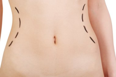 plastik cerrahi, bel düzeltme. 