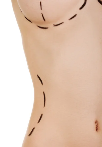 Plastic surgery, waist correction. — Stock Photo, Image