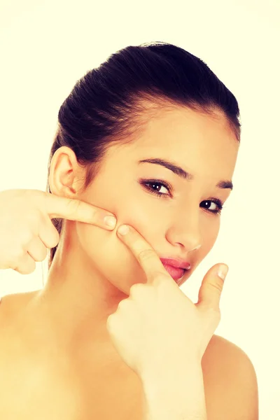 Teenage woman squeezing pimple. — Stock Photo, Image