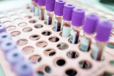 Hastane kan örnekleri, yüksek kalite.