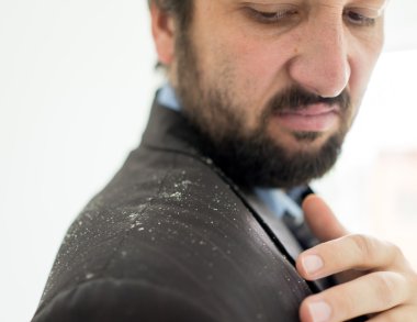 Kepek saç diplerinden sahip bir adam