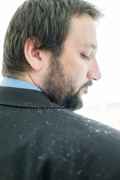 A man having dandruff in the hair — Stock Photo, Image