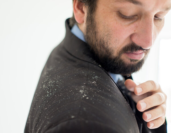 Мужчина с перхоти в волосах
