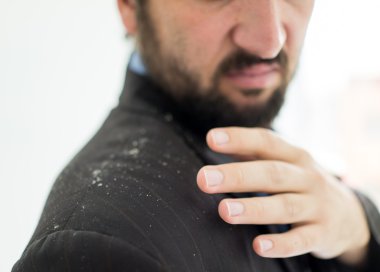 Kepek saç diplerinden sahip bir adam