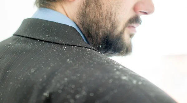 Um homem com caspa de homem no cabelo — Fotografia de Stock