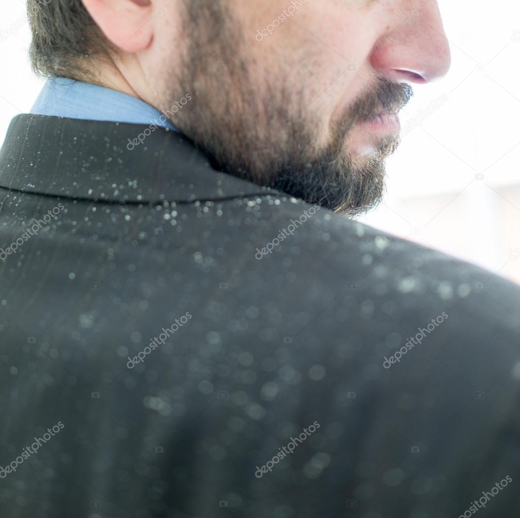 A man having dandruff in the hair