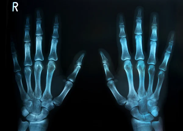 Mänskliga händer x ray — Stockfoto