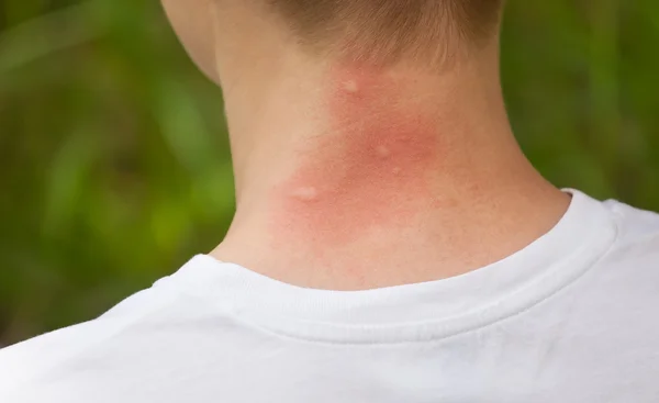 Mosquito bites op de hals. — Stockfoto