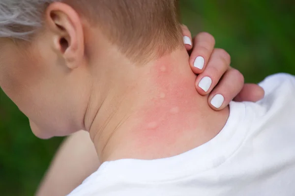 Chica con el pelo rubio, sentado con la espalda vuelta y arañando mordida, rojo, piel hinchada del cuello de las picaduras de mosquitos en el verano en el bosque. Primer plano de las picaduras de insectos visibles. Piel irritada . — Foto de Stock