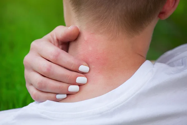 Chica con el pelo rubio, sentado con la espalda vuelta y arañando mordida, rojo, piel hinchada del cuello de las picaduras de mosquitos en el verano en el bosque. Primer plano de las picaduras de insectos visibles. Piel irritada . — Foto de Stock