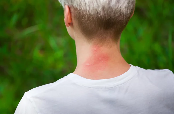 Mosquito bites.Girl with blond hair, sitting with his back turned and scratching bitten, red neck skin from mosquito bites in the summer in the forest.Close-up of visible insect bites.Irritated skin — стоковое фото