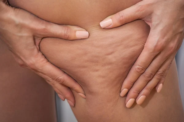 Muchacha muestra sosteniendo y empujando la piel de las piernas celulitis, cáscara de naranja. Tratamiento y eliminación del exceso de peso, depósito de tejido graso subcutáneo — Foto de Stock