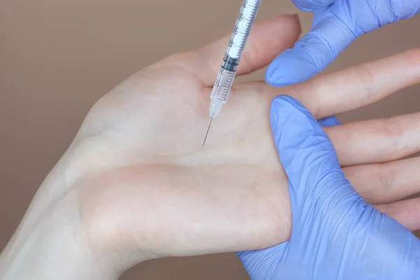Der Arzt Intramuskuläre Injektionen Von Botulinumtoxinon Die Handflächen Einer Frau — Stockfoto