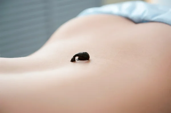 A session of hirudotherapy. Leech therapy — Stock Photo, Image