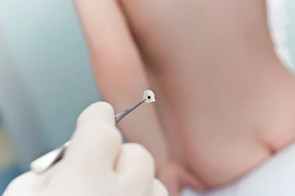 Massage with the help of a metal ball. Tsubotherapy — Stock Photo, Image