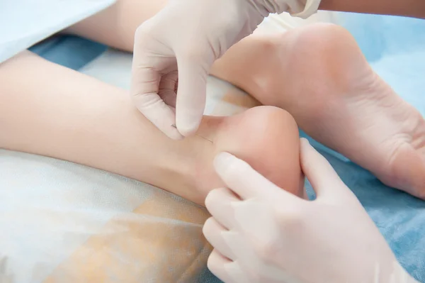 Acupuncture on the foot — Stock Photo, Image