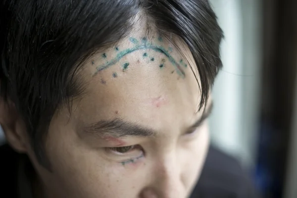 Scar on the head — Stock Photo, Image