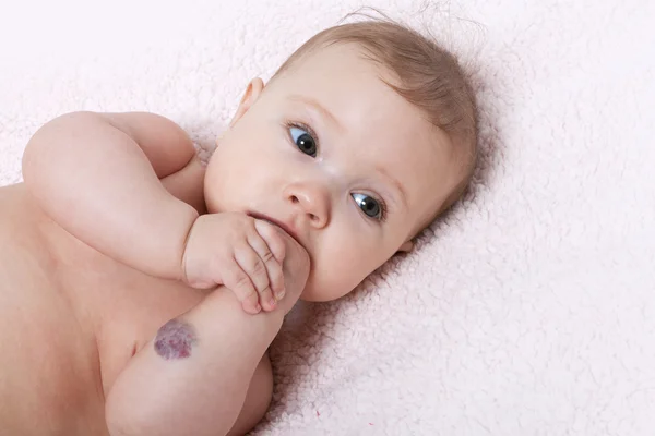 Menina bonito com hemangioma no braço — Fotografia de Stock