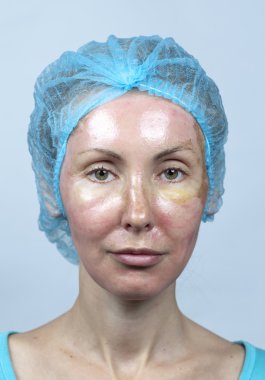 kozmetik. kimyasal peeling, çok hızlı bir eski katmanı silme nedeniyle bir kızarıklık sonra yeni cilt.