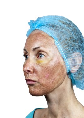 Cosmetology.Skin ret sonra derin kimyasal peeling sırasında. Bir boyun işlenmiş ve sağlıklı cilt arasında sınır