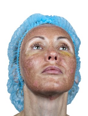 Cosmetology.Skin ret sonra derin kimyasal peeling sırasında. Bir boyun işlenmiş ve sağlıklı cilt arasında sınır