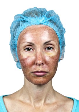 Cosmetology.Skin bir derin kimyasal peelin sonra ret sırasında