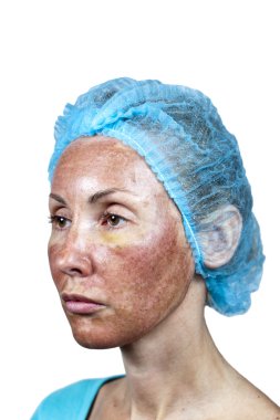 Cosmetology.Skin bir derin kimyasal peelin sonra ret sırasında