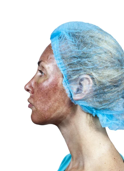 Cosmetology.Skin trakcie odrzucenia po peeling głęboko chemiczny. Granica między przetworzonych i zdrową skórę na szyi — Zdjęcie stockowe