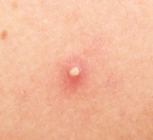 Pimple on the skin close-up — Stock Photo, Image