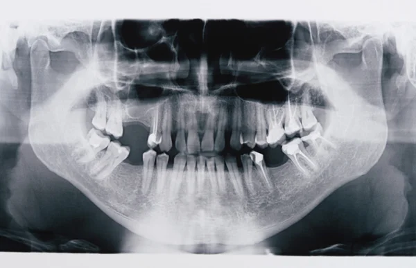 Panoramisch x-ray skan — Stockfoto