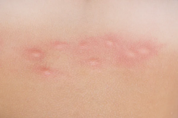 Mosquito bites on skin — Stok Foto