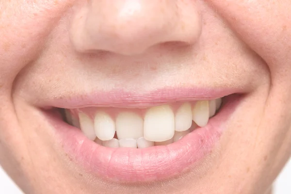 Os dentes tortos de mulher — Fotografia de Stock