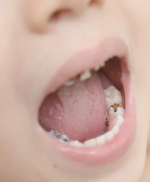 Dents de bébé avec caries — Photo