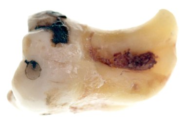 Beyaz arkaplanda yirmilik diş izole