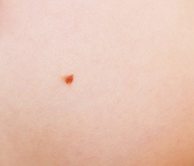 İnsan derisindeki ben.