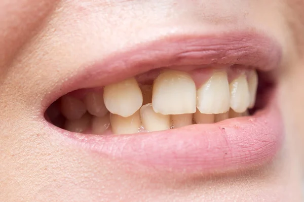 Primer Plano Los Dientes Mujer — Foto de Stock