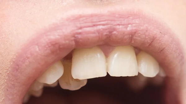 Primo Piano Colpo Denti Storti — Foto Stock