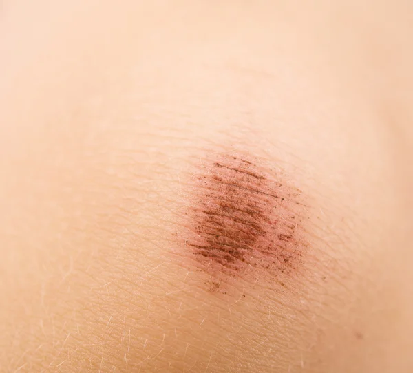 Scraped knee — Stock Photo, Image