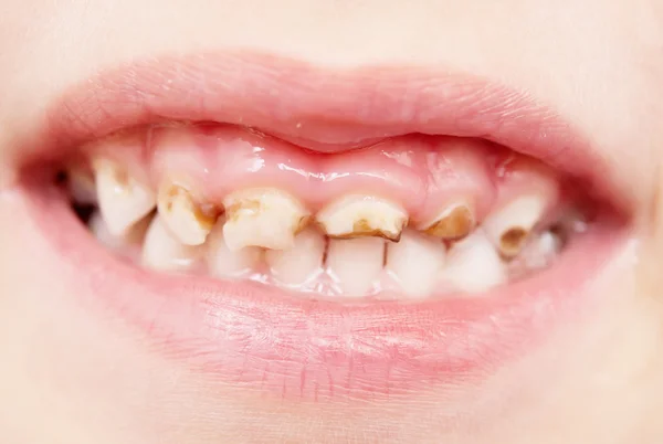 Denti cattivi — Foto Stock