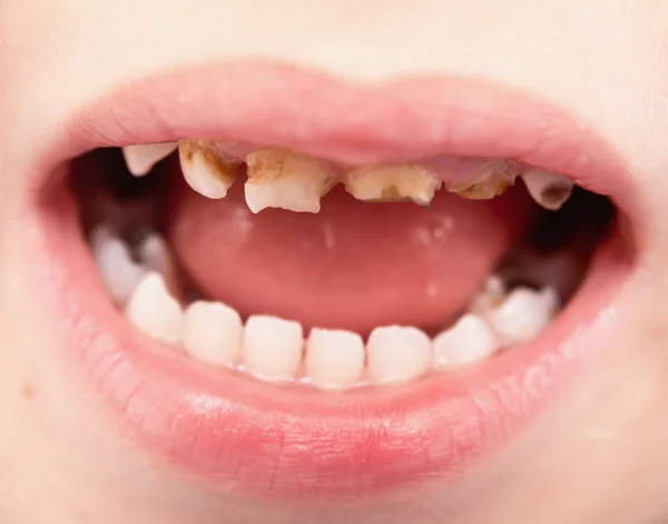 Uthealthy teeth — Stock Photo, Image