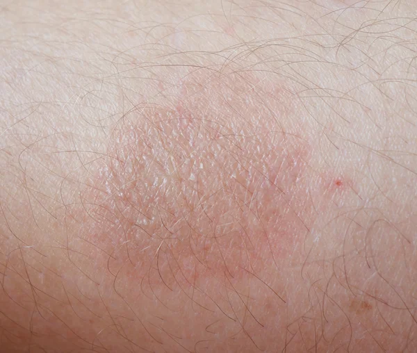 Burn on skin — Stock Photo, Image