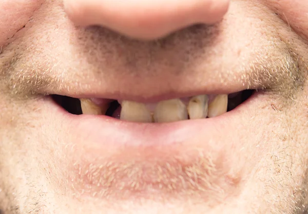 Špatné zuby — Stock fotografie