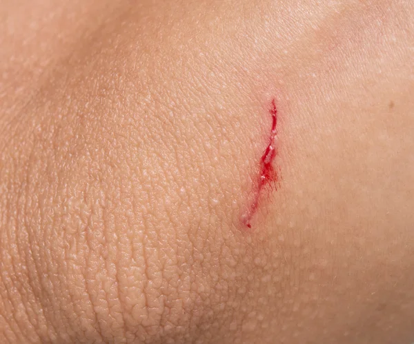 Wound — Stock Photo, Image