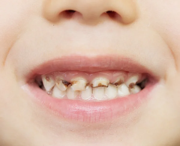 Dentes maus — Fotografia de Stock