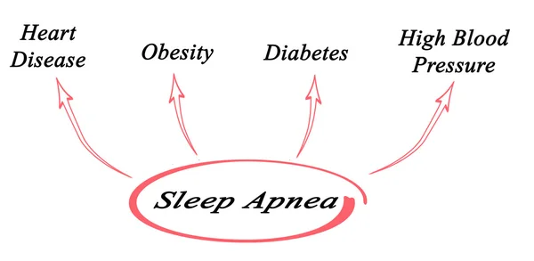 Diagrama de la apnea del sueño — Foto de Stock