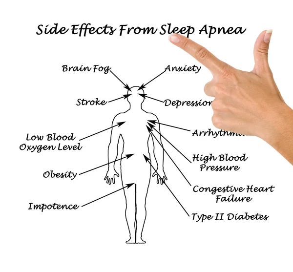 Эффекты сифе от апноэ сна — стоковое фото