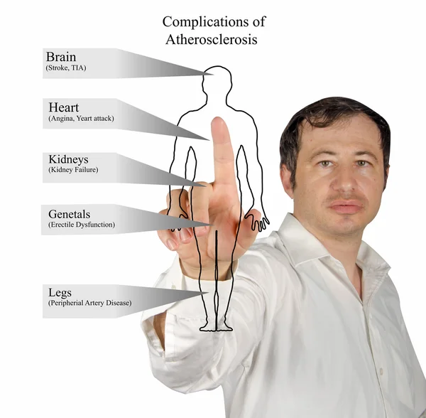 Complications of Atherosclerosis — Stock Photo, Image